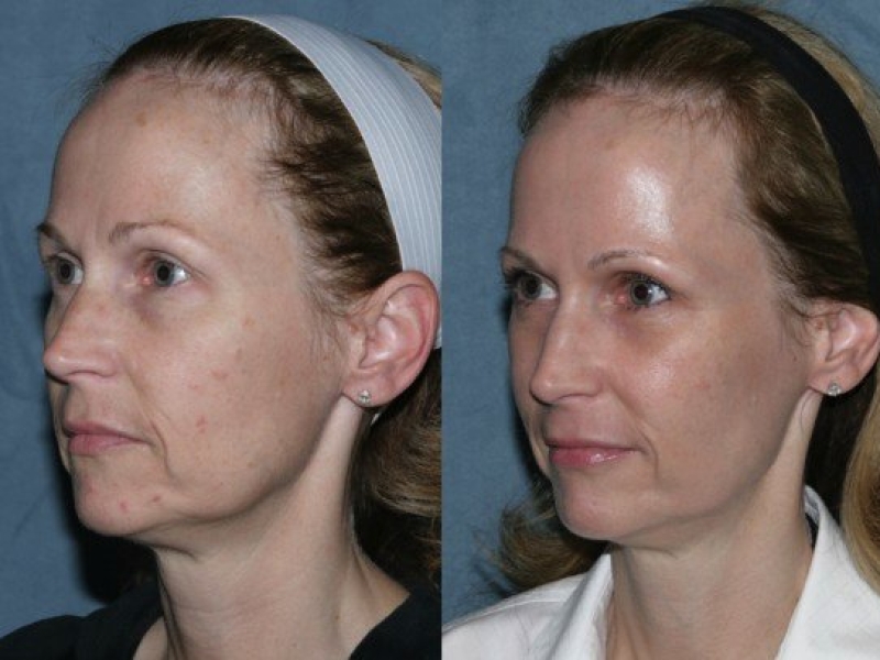3D Hifu (High Intensity Focused Ultrasound), SMAS -лифтинг в Кишиневе!